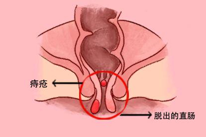 痣的图片