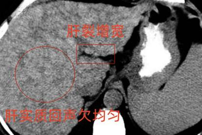 肝硬化声像图晚期
