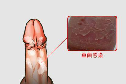 真菌感染图