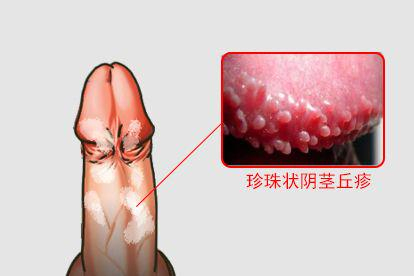 珍珠状阴茎丘疹图
