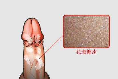 花斑糠疹图