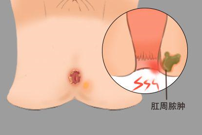 肛门整圈黑红糜烂图片肛周脓肿