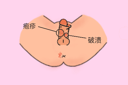 生殖器疱疹图