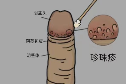 局部用药图
