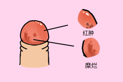 包皮龟头炎图