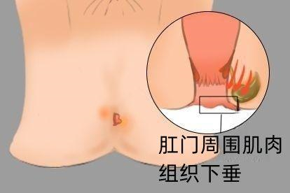 痔疮囊肿图片肛门坠胀感