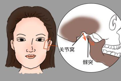 颞下颌关节脱位图