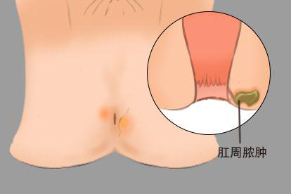 肛门迂曲静脉团块图肛周脓肿
