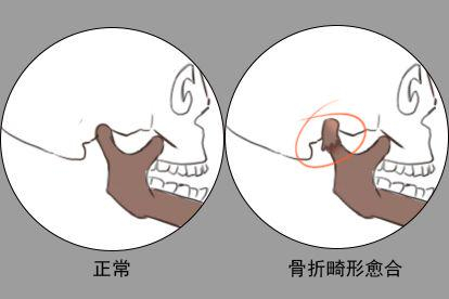 骨折畸形愈合图