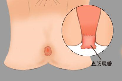 直肠脱垂