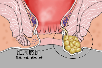 肛周脓肿图
