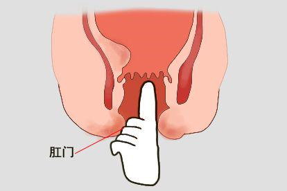 肛门息肉图片直肠指检