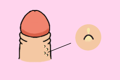 粟丘疹图