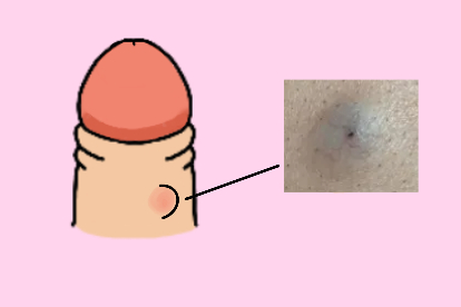 皮脂腺囊肿图