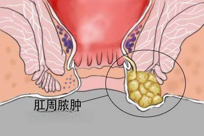 肛周脓肿图