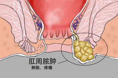 肛周脓肿图