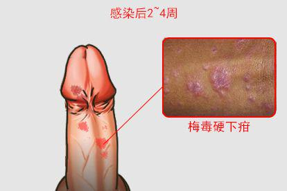 一期梅毒图