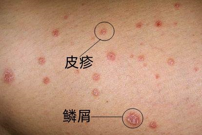 皮屑图