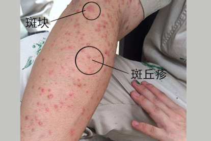 手臂梅毒照片