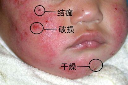 湿疹症状图