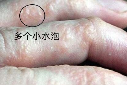 汗疱疹症状图