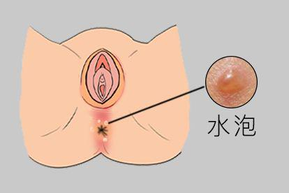 肛周湿疹图