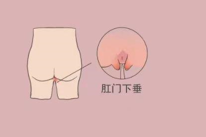肛门痔疮图片肛门坠胀感