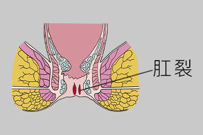 肛裂图