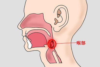咽喉肿瘤发生在喉部图