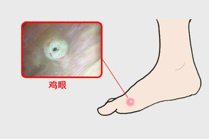 鸡眼图
