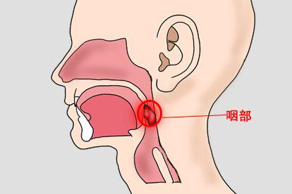 咽喉肿瘤发生在咽部图