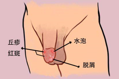 真菌感染图