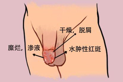 龟头炎图
