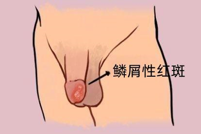 银屑病图