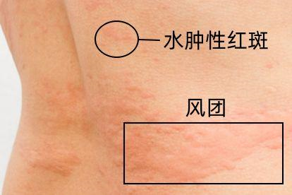 皮疹图