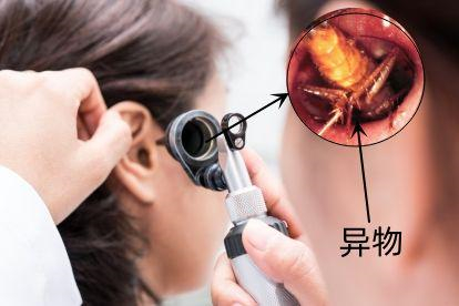 耳朵里有红色异物图片外耳道异物