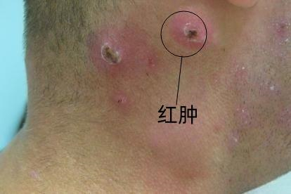 耳朵后面痛疖肿图片