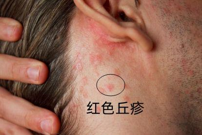 耳朵后面痛外耳道炎图片