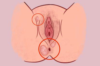 肛窦炎图