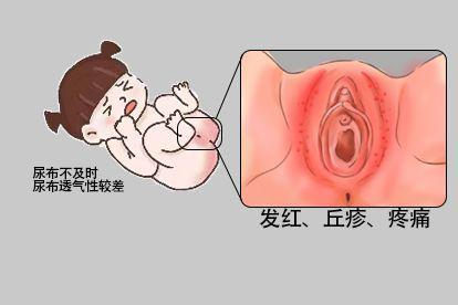 尿布皮炎图
