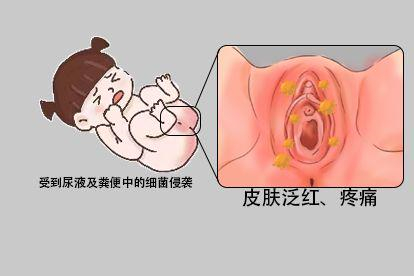 外阴炎图