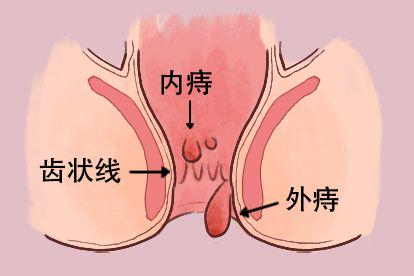 痔疮图