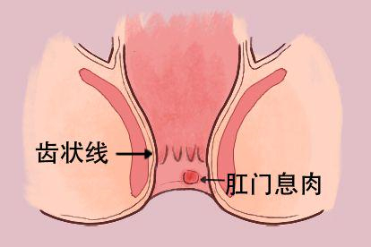 肛门息肉图
