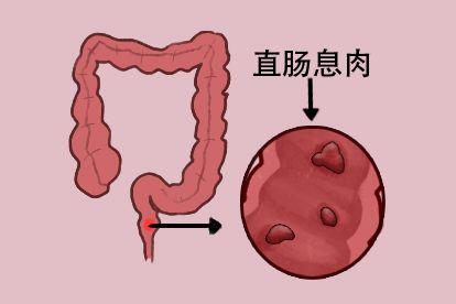 直肠息肉图