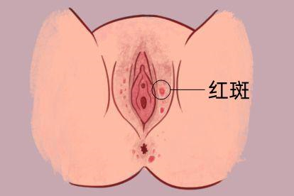 一期梅毒症状图