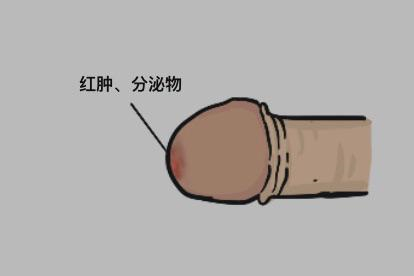 尿道炎图