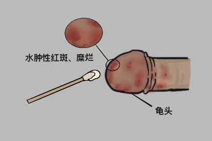 龟头炎图