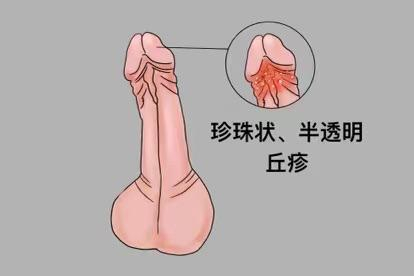 珍珠状阴茎丘疹图