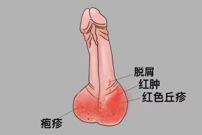 阴囊湿疹图