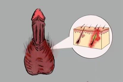 毛囊炎图